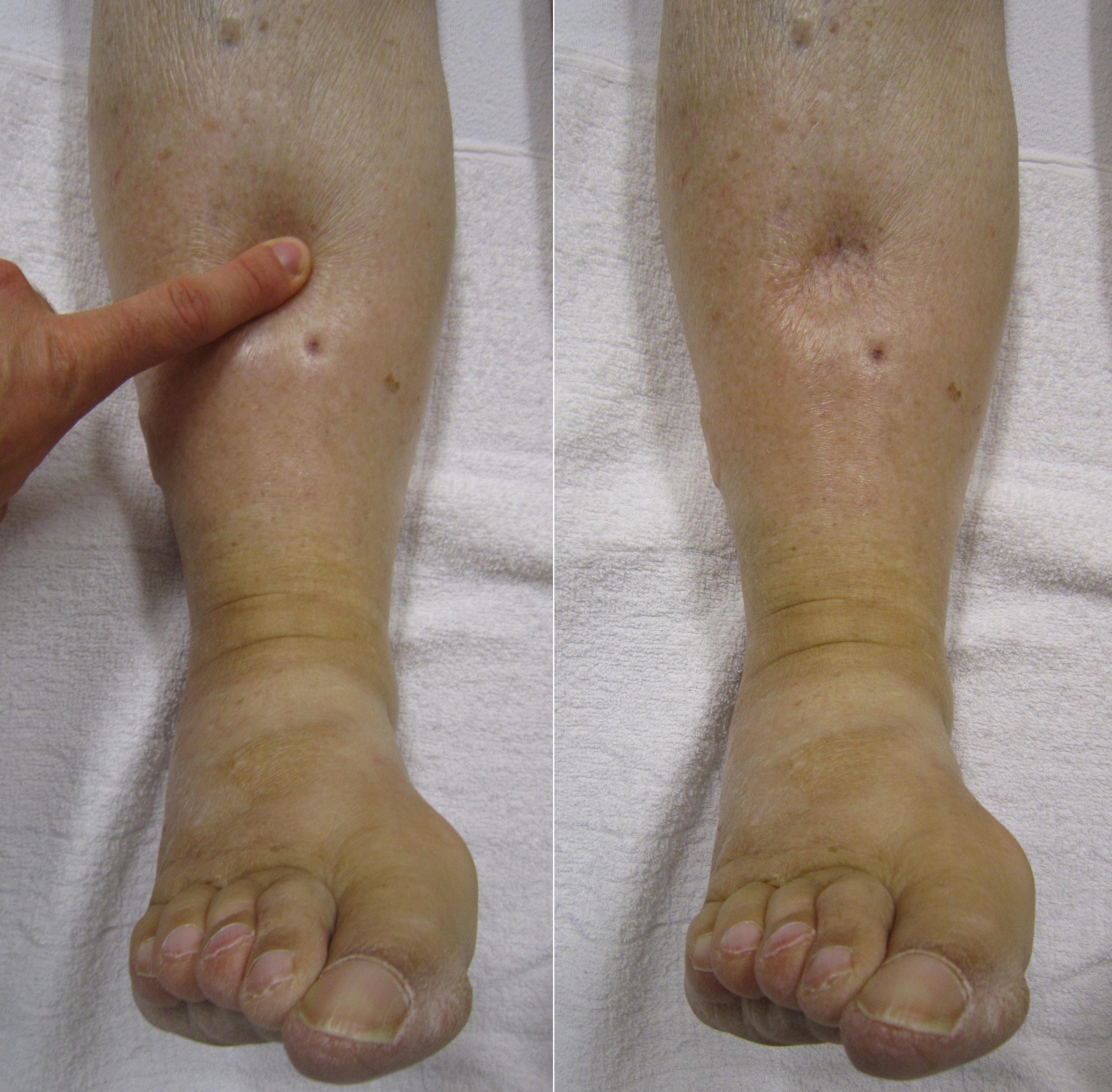 “Combinpedal.jpg” by James Heilman, MD is licensed under CC BY-SA 3.0 Image showing edema on lower leg, after finger press