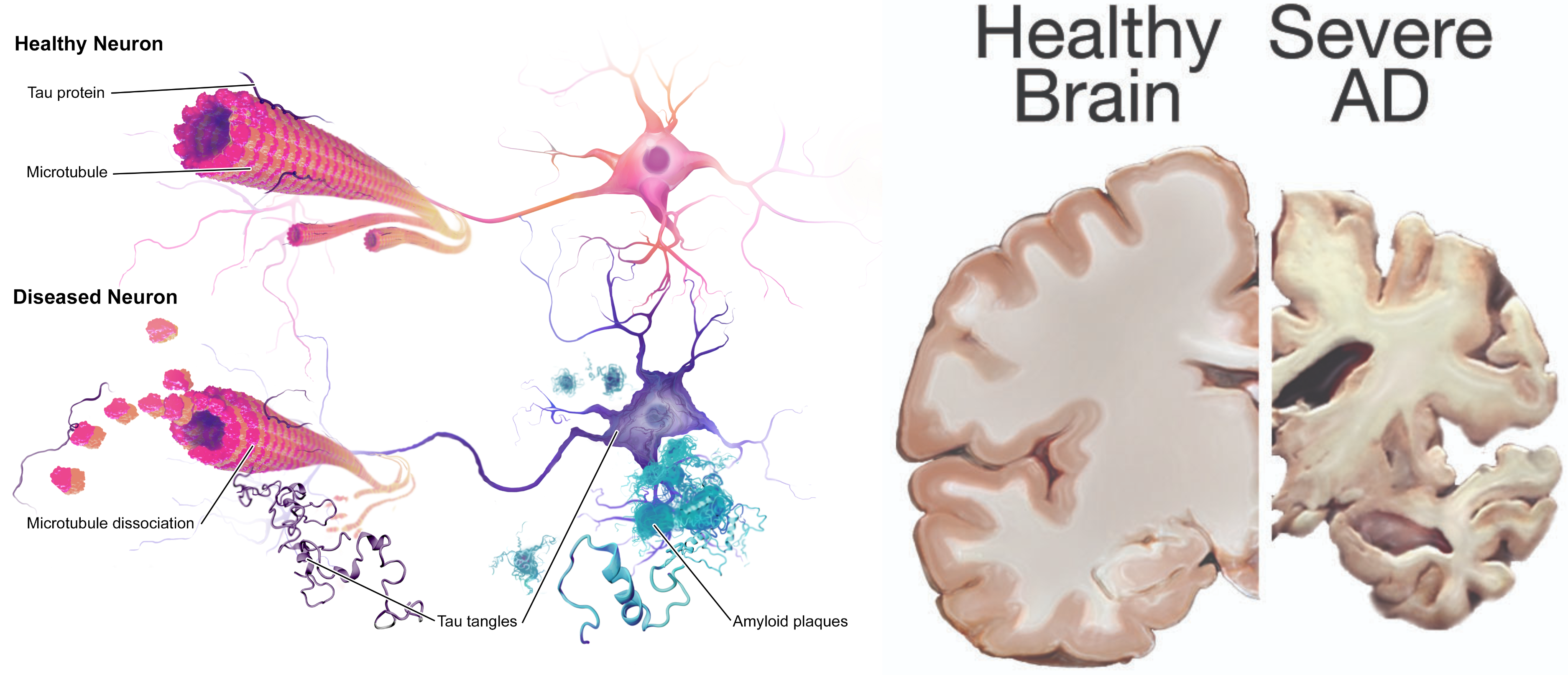 “Alzheimers_Disease.jpg” by BruceBlaus is licensed under CC BY-SA 4.0 and “24239522109_6b061a9d69_o.jpg” by NIH Image Gallery is licensed under CC0 Images showing brain and neurons affected by Alzheimer’s Disease, with labels