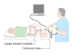 “Diagram_showing_a_colonoscopy_CRUK_060.svg” by Cancer Research UK is licensed under CC BY-SA 4.0 Illustration demonstrating a Colonoscopy