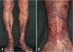 ”3056fig1_opt.jpeg” by unknown is licensed under CC BY-NC 4.0 Access for free at https://www.medicaljournals.se/acta/content/html/10.2340/00015555-0692 Photo showing Stasis Dermatitis Due to Venous Insufficiency