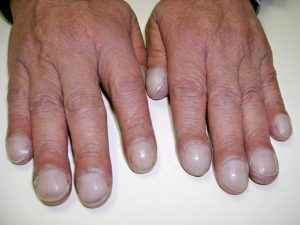 “Acopaquia.jpg” by Desherinka is licensed under CC BY-SA 4.0 Photo showing Clubbing of Fingertips