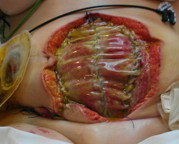 “Bogota bag.png” by Suarez-Grau JM, Guadalajara Jurado JF, Gómez Menchero J, Bellido Luque JA is licensed under CC BY 4.0 Photo showing dehicence on abdominal wound