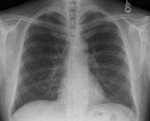 “Chest Xray PA 3-8-2010.png” by Stillwaterising is licensed under CC0 Image of a Chest X-ray