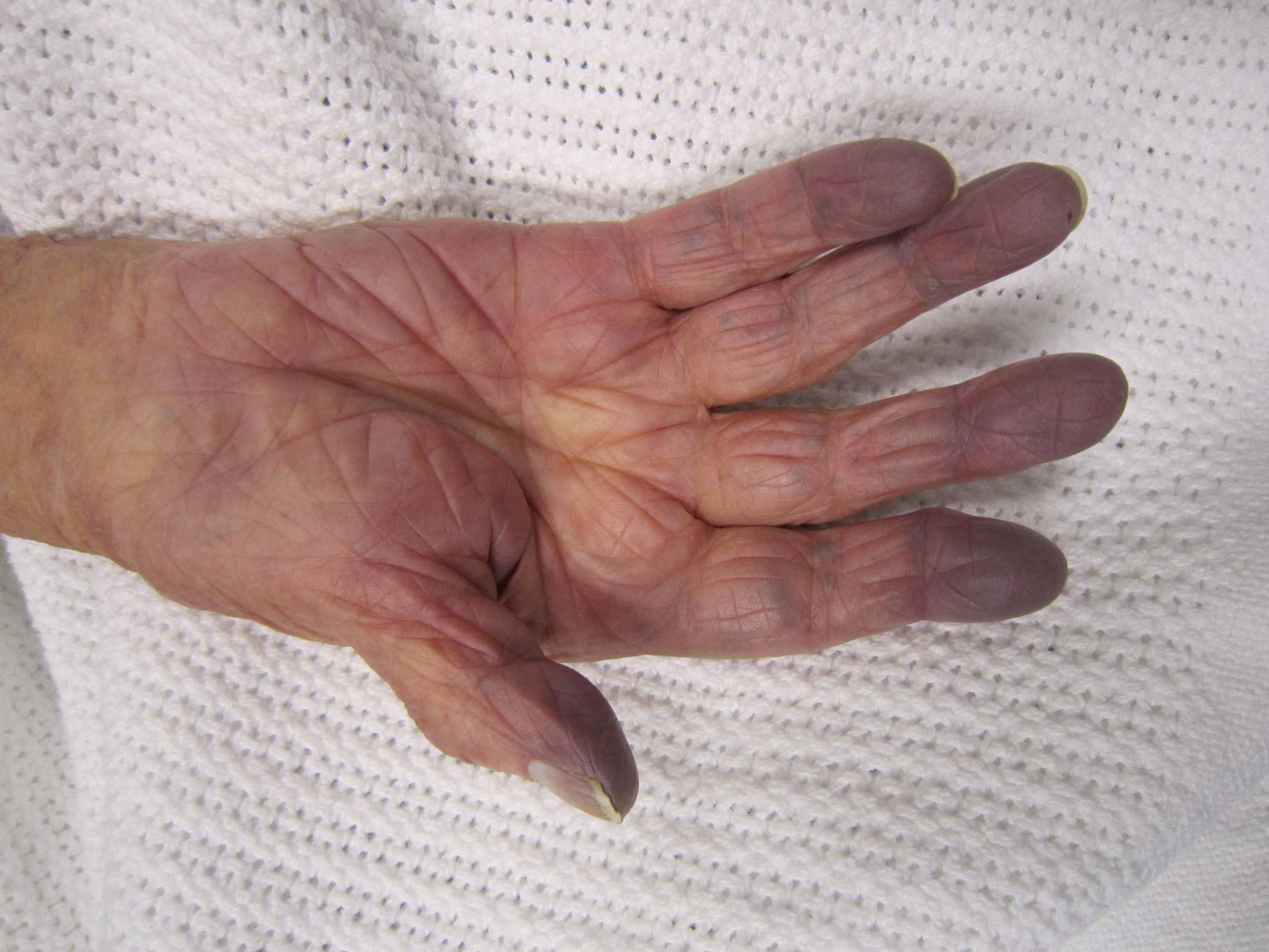 “Cynosis.JPG” by James Heilman, MD is licensed under CC BY-SA 3.0 Photo showing hand with cyanosis on fingertips