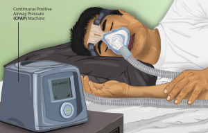 “Depiction_of_a_Sleep_Apnea_patient_using_a_CPAP_machine.png” by https://www.myupchar.com/en is licensed under CC BY-SA 4.0 Illustration showing CPAP in use