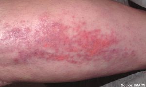 “Dermatomyositis15.jpg” by Elizabeth M. Dugan, Adam M. Huber, Frederick W. Miller, Lisa G. Rider is licensed under CC BY-SA 3.0 Photo showing excoriation