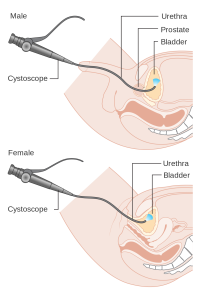 “Diagram_showing_a_cystoscopy_for_a_man_and_a_woman_CRUK_064.svg” by Cancer Research UK is licensed under CC BY-SA 4.0 Illustration showing cystoscopy on both a male and a female