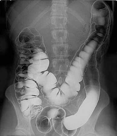 “Human_intestinal_tract,_as_imaged_via_double-contrast_barium_enema.jpg” by Glitzy queen00 at English Wikipedia is in the Public Domain Image showing x-ray of barium enema results