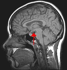 “Hypothalamus.jpg” by Methoxyroxy~commonswiki is in the Public Domain Image showing an arrow pointing to the hypothalamus in the brain