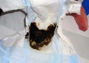 “Meconium_Diaper.jpg” by Azoreg is licensed under CC BY-SA 3.0 Image showing meconium in a diaper