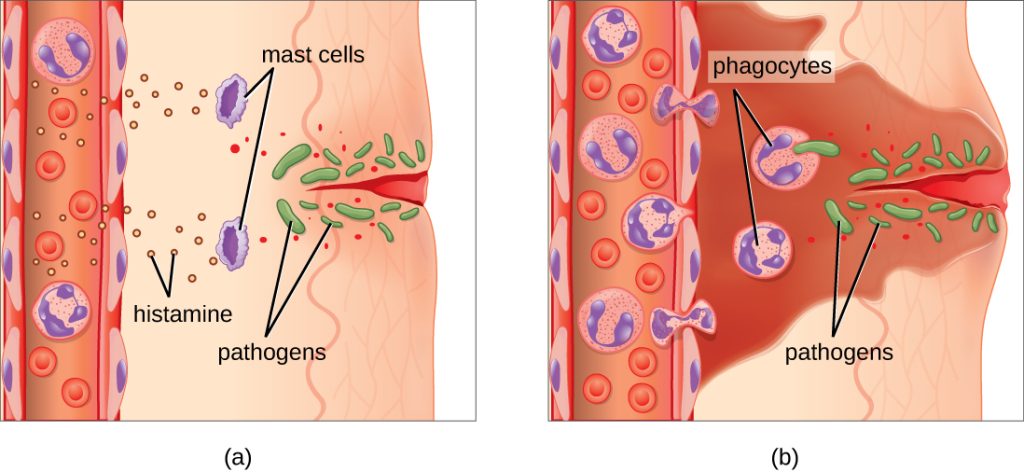 “OSC_Microbio_17_06_Erythema.jpg” by CNX OpenStax is licensed under CC BY 4.0. Access for free at https://openstax.org/books/microbiology@9.8/pages/17-5-inflammation-and-fever. Image showing inflammatory response, with labels