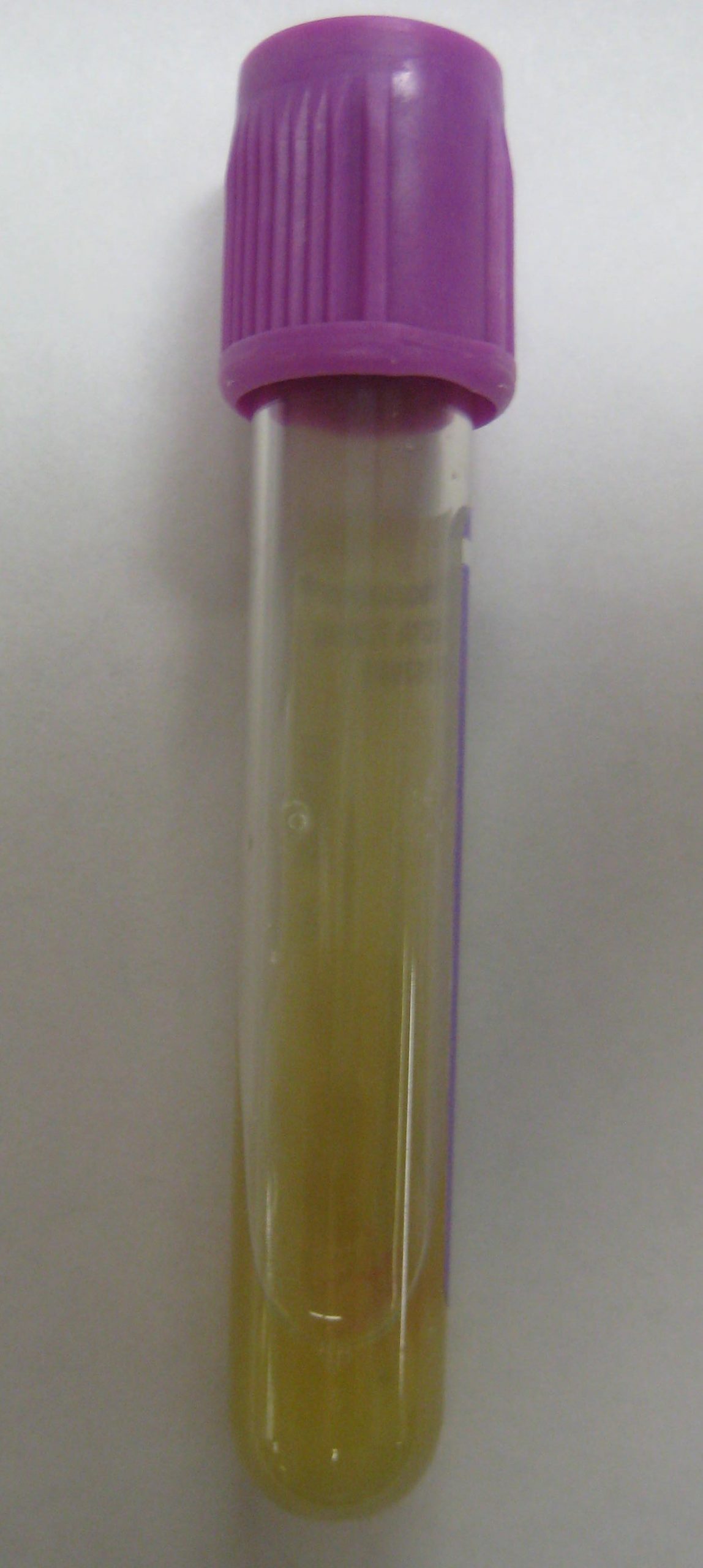 “Purulent knee aspirate.JPG” by James Heilman, MD is licensed under CC BY 3.0 Photo showing a vial of purulent drainage
