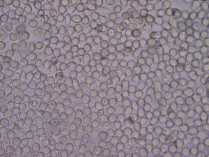 “Pyuria2.JPG” by Bobjgalindo is licensed under CC BY-SA 4.0 Image showing micrograph of Urinalysis Demonstrating White Blood Cells
