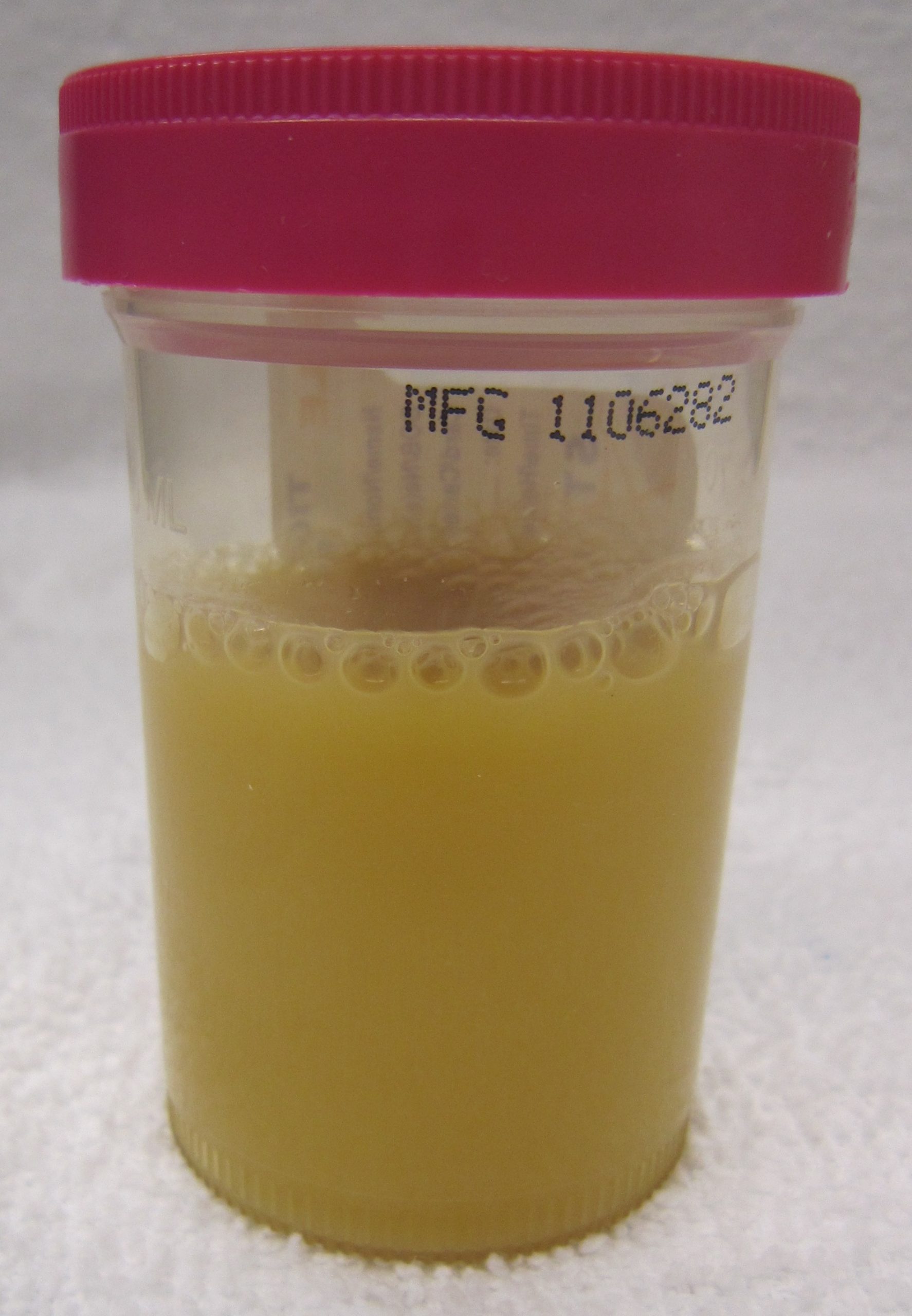 “Pyuria2011.JPG” by James Heilman, MD is licensed under CC By-SA 3.0 Image showing a container of pyuria