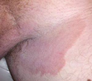 “Tinea cruris.jpg” by Robertgascoin is licensed under CC BY-SA 3.0 Photo showing Fungal Infection in the Groin