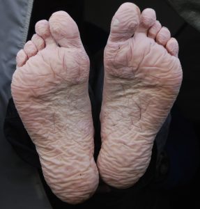 “Trench_foot.jpg” by Mehmet Karatay is licensed under CC BY-SA 3.0 Photo showing maceration on feet