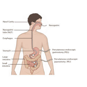 “Types and Placement of Enteral Tubes” by Meredith Pomietlo for Chippewa Valley Technical College is licensed under CC BY 4.0) Image showing types and placement of enteral tubes, with text labels