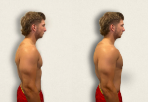 “Normal A-P Chest Image.jpg" and "Barrel Chest.jpg" by Meredith Pomietlo for Chippewa Valley Technical College are licensed under CC BY 4.0 Photo showing a side view of normal and barrel chest appearance of simulated patient