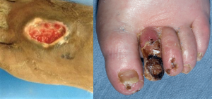 ”JCCD147F1.gif” and “nfective-necrosis-of-second-toe_fig5_40484391” by unknown are licensed under CC BY 4.0 and CC BY-NC 4.0 Access for free at https://www.sciforschenonline.org/journals/clinical-cosmetic-dermatology/JCCD147.php and https://www.researchgate.net/figure/nfective-necrosis-of-second-toe_fig5_40484391 Photos showing Arterial Insufficiency Ulcer and Necrotic Toes