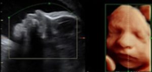 2D and 3D ultrasound images of a fetus at approximately 22 weeks to 32 weeks of gestation