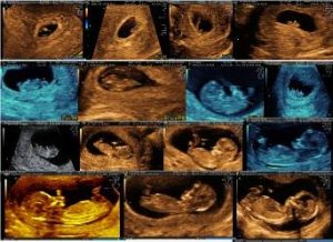 Ultrasound image of first trimester pregnancy between 6th week and 13 weeks.