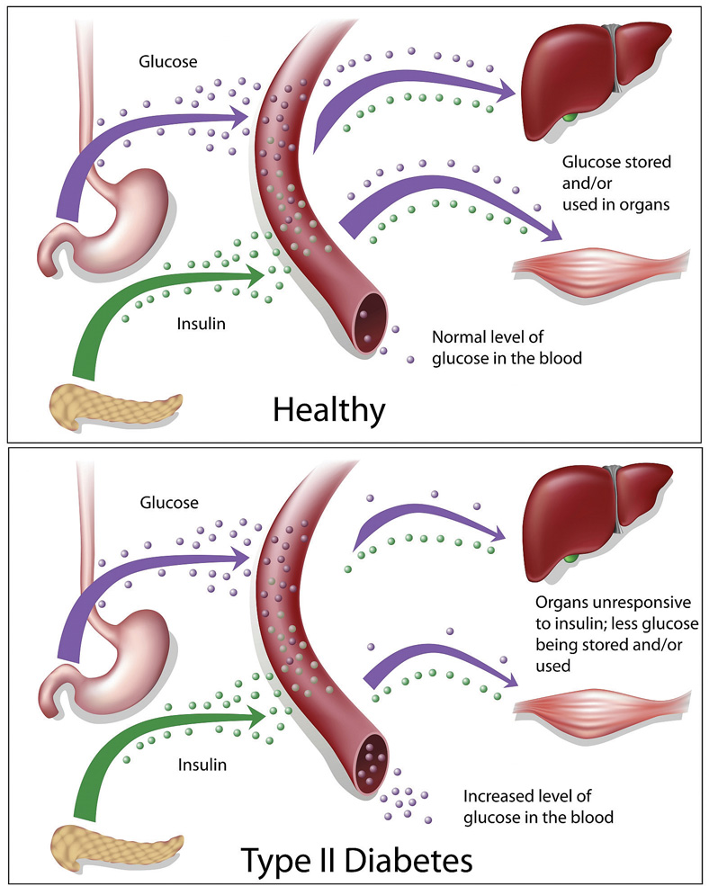Diagram showing the differences in insulin resistance in the body of a healthy individual versus an individual with type 2 diabetes