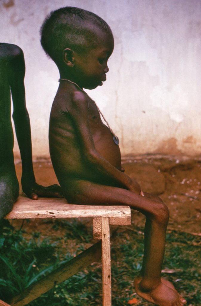 Malnourished child suffering from protein deficiency.