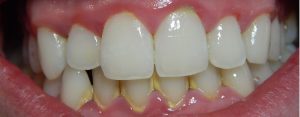 Close up image of teeth showing signs of gingivitis