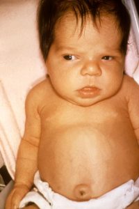 Image of a newborn baby with jaundice