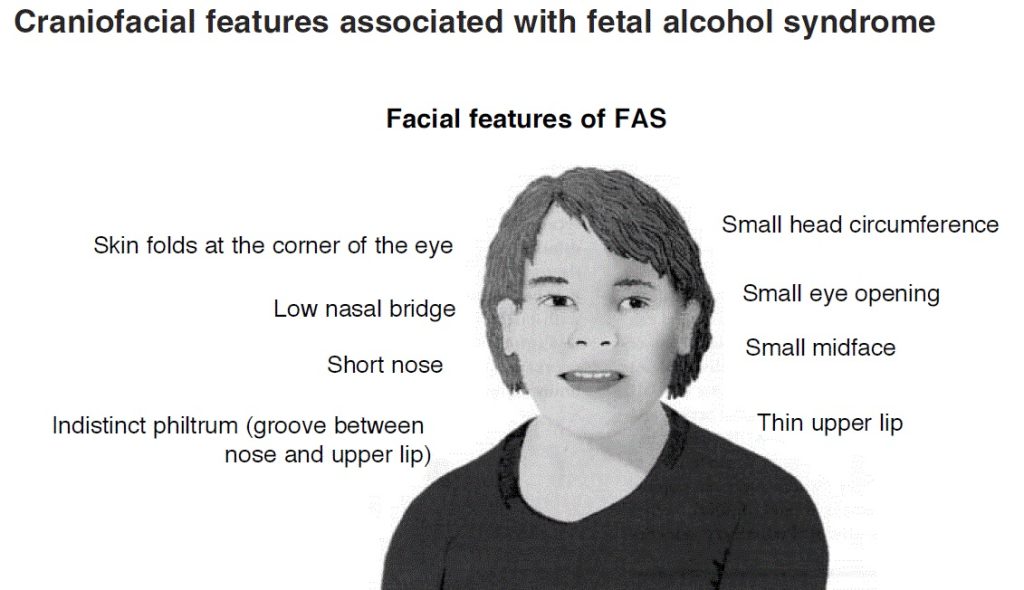 Diagram showing typical facial features of fetal alcohol syndrome