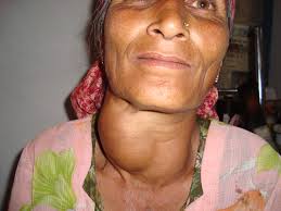 Image of a woman with large goiter on neck