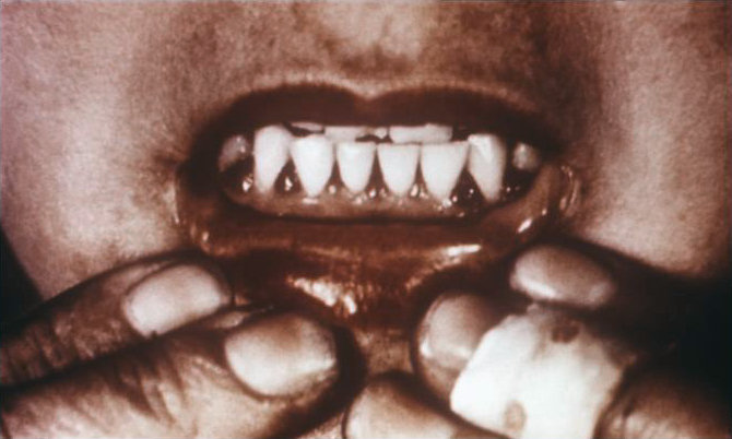 Image of bleeding gums in a patient's mouth