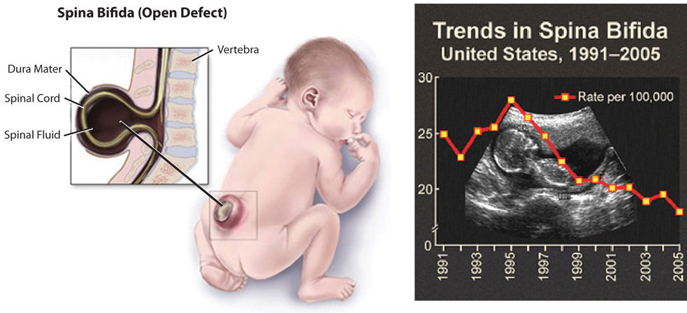 Series of images showing the spinal deformations of spina bifida (open defect), the location of the defect on the body of a human newborn, and trends in spina bifida in the U.S. from 1991-2005