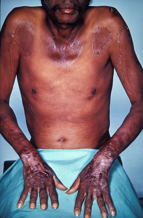 Image showing the effects of pellagra, a disease resulting from niacin deficiency