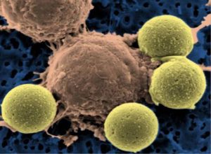 A large brown cell - a CAR T cell - surrounded by four smaller, pea-green beads. The CAR T cell has more irregularities on the surface than the beads.