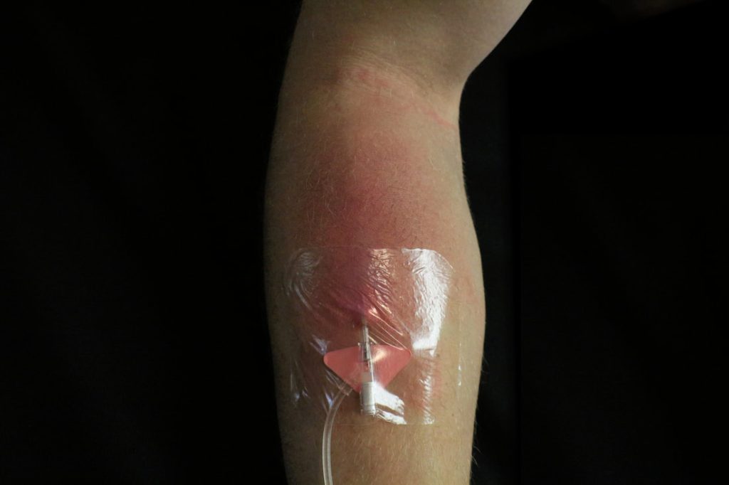 Arm with redness at IV site