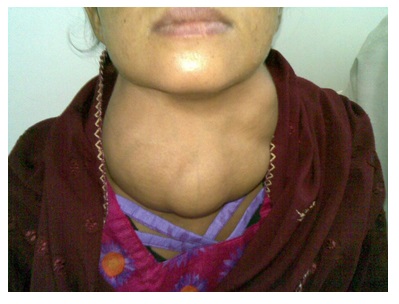 A photograph of an individual with a goiter.