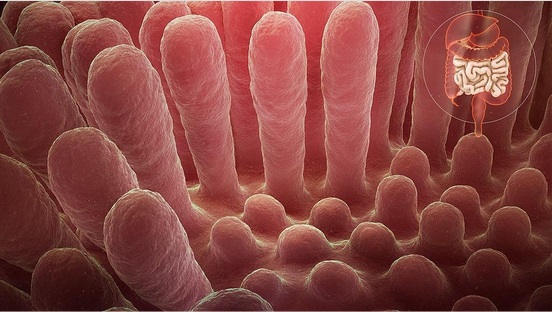 Representation of the structure of healthy villi and celiac-affected villi. Inflammation has caused the villi to deform, reducing their ability to function efficiently, if at all.