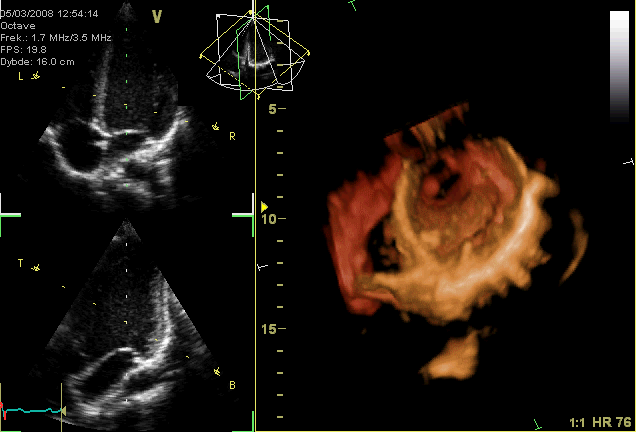Animated echocardiogram showing both 2D and 3D cardiac views. The left side of the image displays two grayscale two-dimensional echocardiographic slices of the beating heart, revealing the chambers and valve movements during the cardiac cycle. The right side presents a color-enhanced, three-dimensional reconstruction of the heart, rotating slightly to visualize the inner structure and motion of the ventricles and valves in real time. The animation demonstrates normal heart contractions and rhythm.