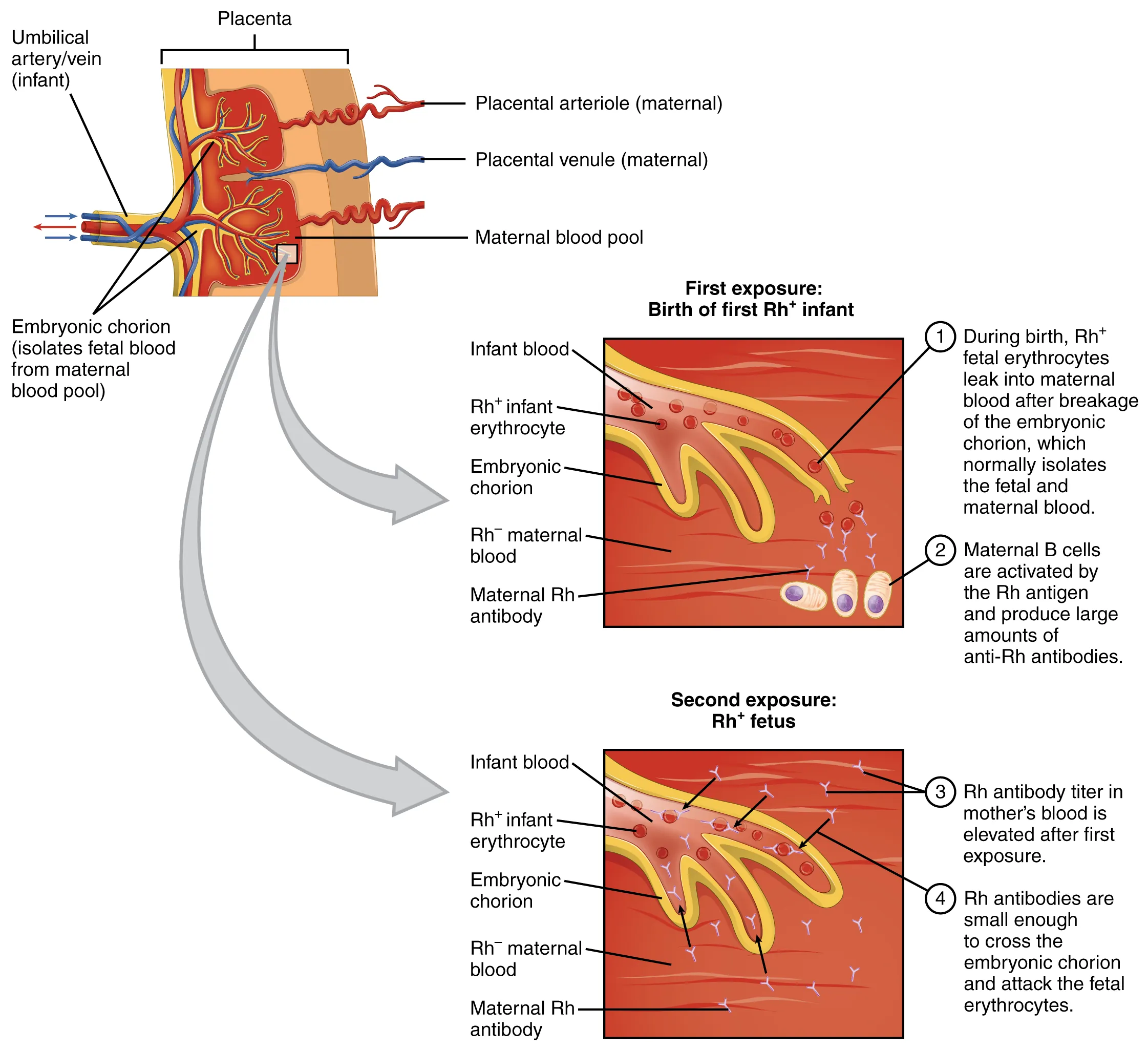 This figure shows an umbilical artery and vein passing through the placenta on the top left. The top right panel shows the first exposure to Rh+ antibodies in the mother. The bottom right panel shows the response when the second exposure in the form of another fetus takes place. Textboxes detail the steps in each