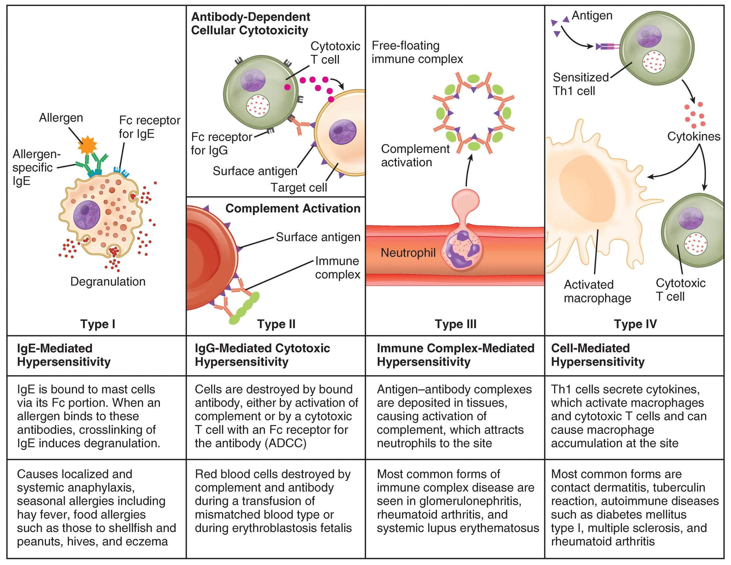 This table describes different types of hypersensitivity. In Type I (IgE-Mediated Hypersensitivity), IgE is bound to mast cells via its Fc portion. When an allergen binds to these antibodies, crosslinking of IgE induces degranulation. Type I causes localized and systemic anaphylaxis, seasonal allergies