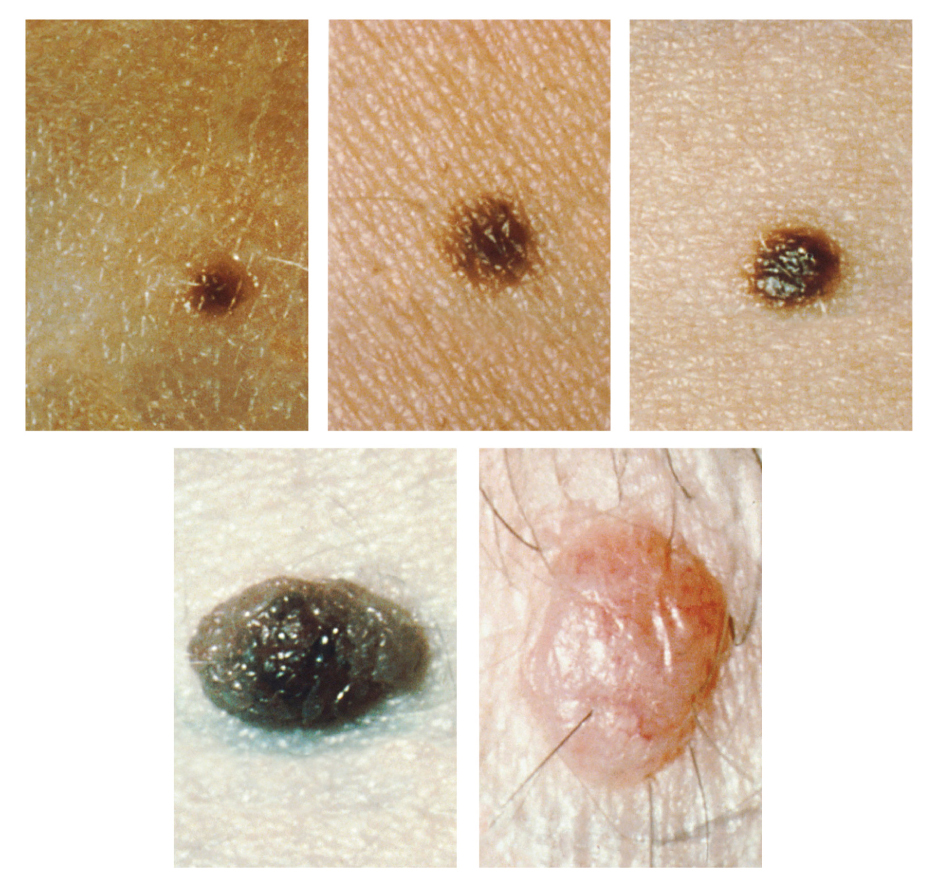 “508 Moles.jpg” by OpenStax College is licensed under CC BY 3.0. Access for free at https://openstax.org/books/anatomy-and-physiology/pages/5-1-layers-of-the-skin. Photo showing several images of moles on skin