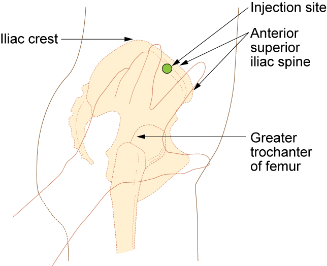 “Im-ventrogluteal-300x244.png” by British Columbia Institute of Technology (BCIT) is licensed under CC BY 4.0. Access for free at https://opentextbc.ca/clinicalskills/chapter/6-8-iv-push-medications-and-saline-lock-flush/ Illustration showing how to locate the ventrogluteal site
