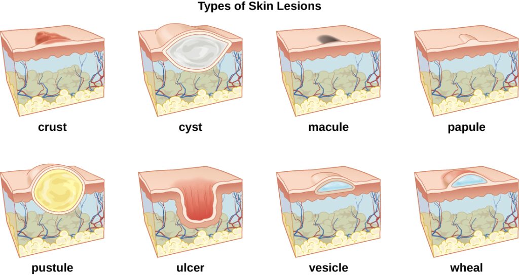 “OSC Microbio 21 01 LesionLine.jpg” by CNX OpenStax is licensed under CC BY 4.0. Access for free at https://openstax.org/books/microbiology/pages/21-1-anatomy-and-normal-microbiota-of-the-skin-and-eyes. Illustration showing eight types of skin lesions