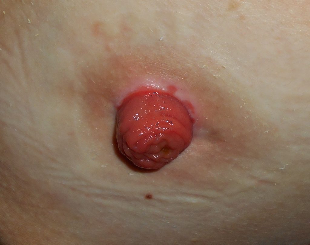 ”Ileostomy 2017-02-20 5351.jpg” by Salicyna is licensed under CC BY-SA 4.0 Photo showing closeup of a ileostomy stoma