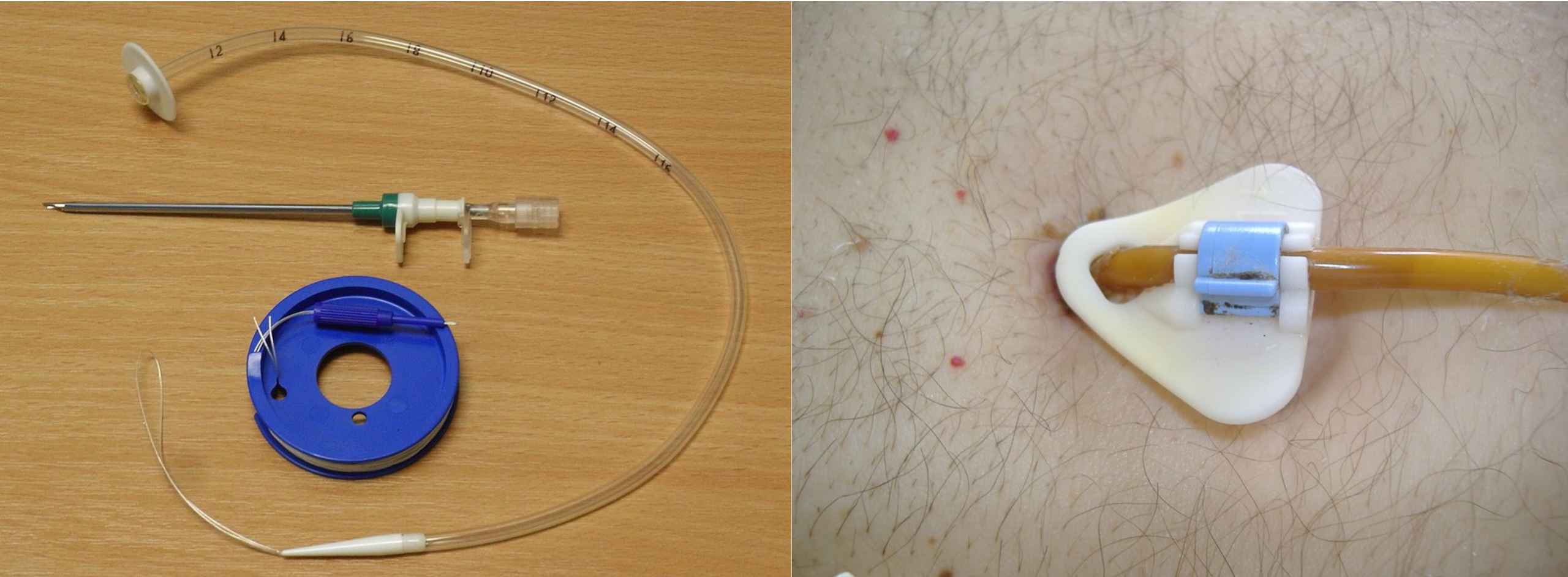 Photo showing P E G Tube both before and during use