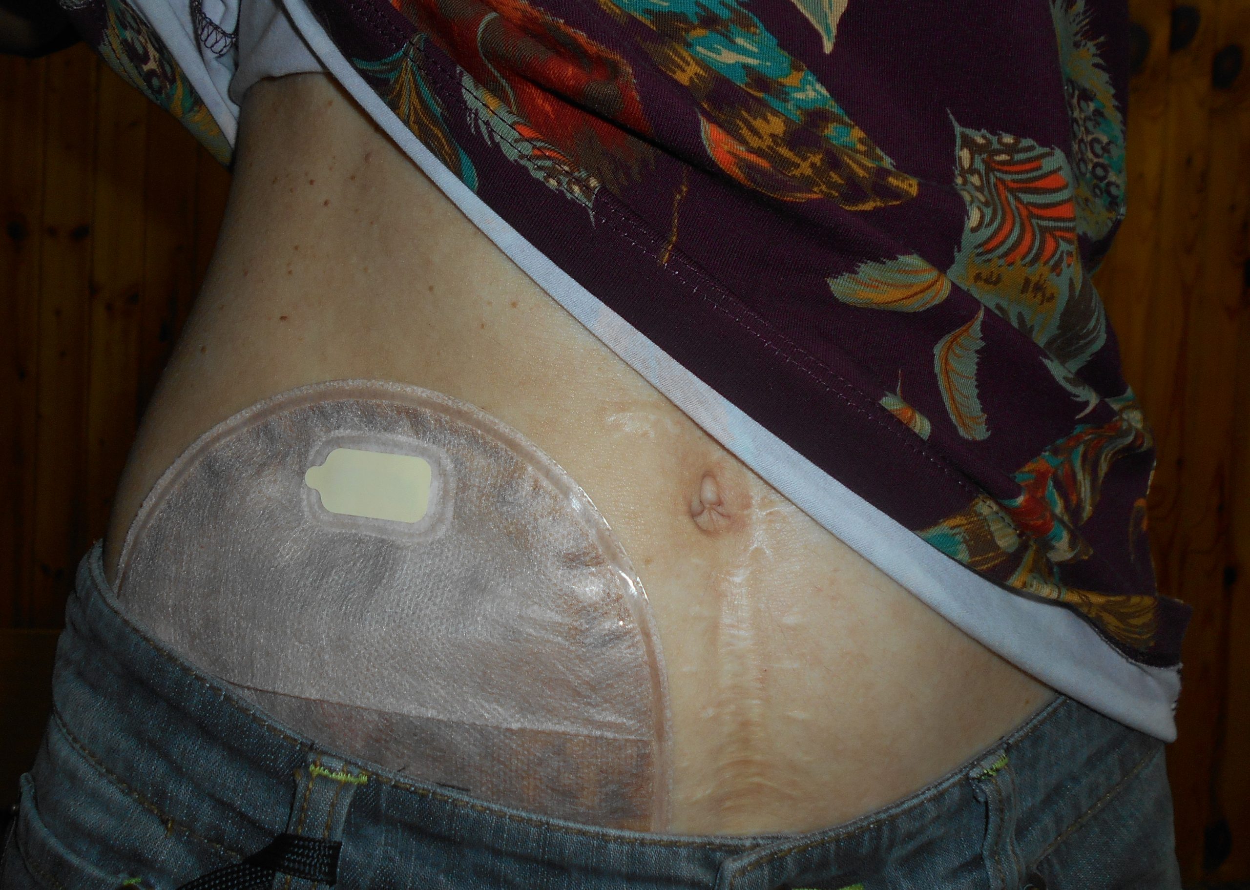 ”Ileostomy_2016-09-09_4158.jpg” by Salicyna is licensed under CC BY-SA 4.0 Photo showing Ileostomy Appliance with a Pouch Attached