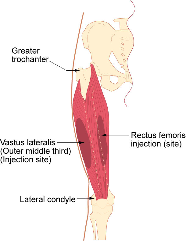 “Im-vastus-lateralis.png” by British Columbia Institute of Technology (BCIT) is licensed under CC BY 4.0. Access for free at https://opentextbc.ca/clinicalskills/chapter/6-7-intradermal-subcutaneous-and-intramuscular-injections/ Illustration showing vastus lateralis site, with labels