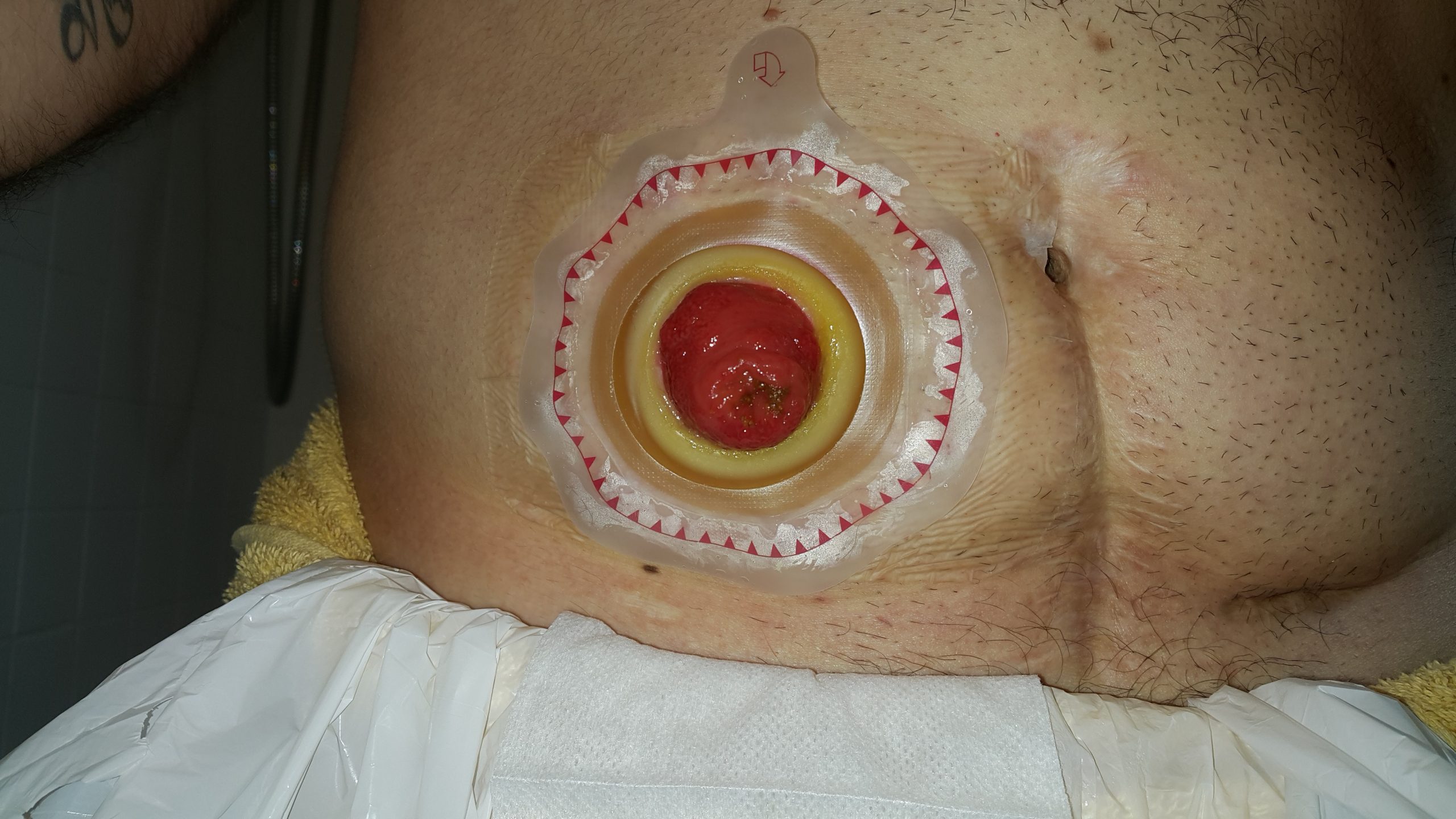 ”Ostomy_wafer_being_worn_by_an_ileostomy_patient.jpg” by Eric Polsinelli (VeganOstomy) is licensed under CC BY 4.0 Photo showing Stoma with a Wafer Barrier