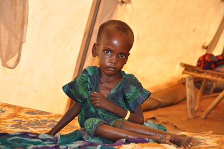Photo of a malnourished child.